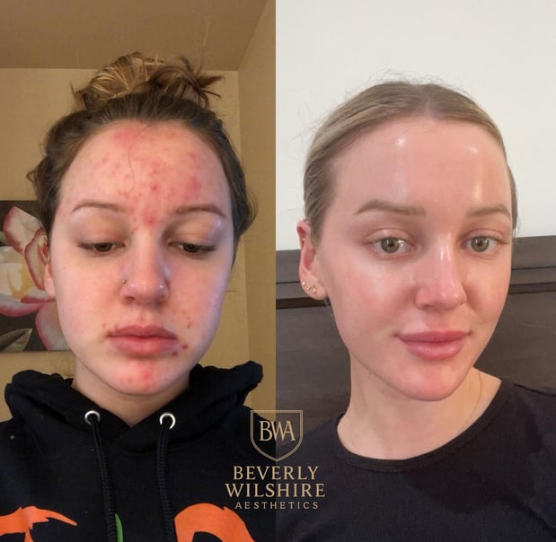 Images Beverly Wilshire Aesthetics Beverly Hills Medical Spa for Botox, Morpheus8, IPL, Lip Fillers