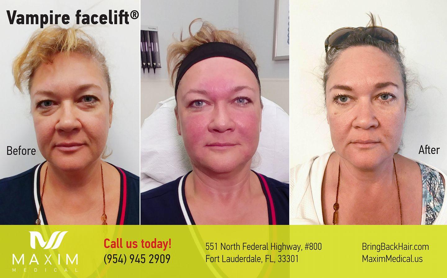 PRP Facelift actual patient before, during and 2 months after procedure