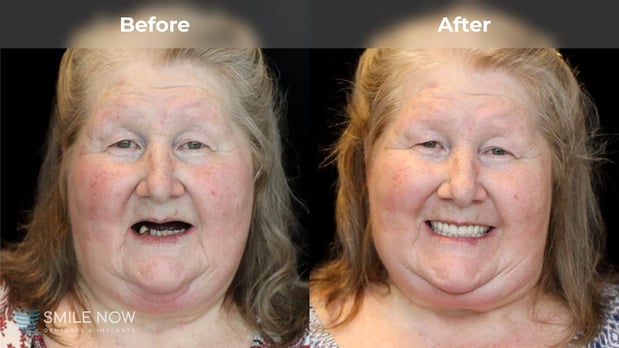 Images Smile Now Milwaukee Dentures and Implants