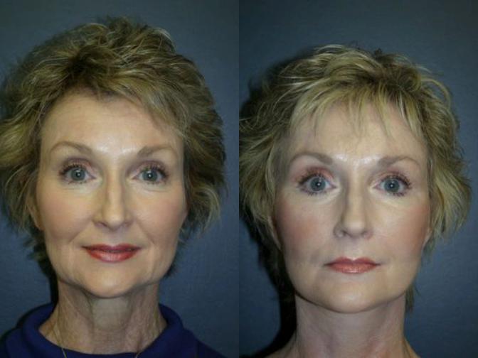 Before & After from O'Brien Plastic Surgery: Kevin M. O'Brien, MD | Birmingham, AL