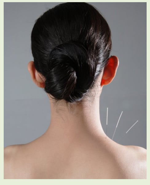 Images Acupuncture Right