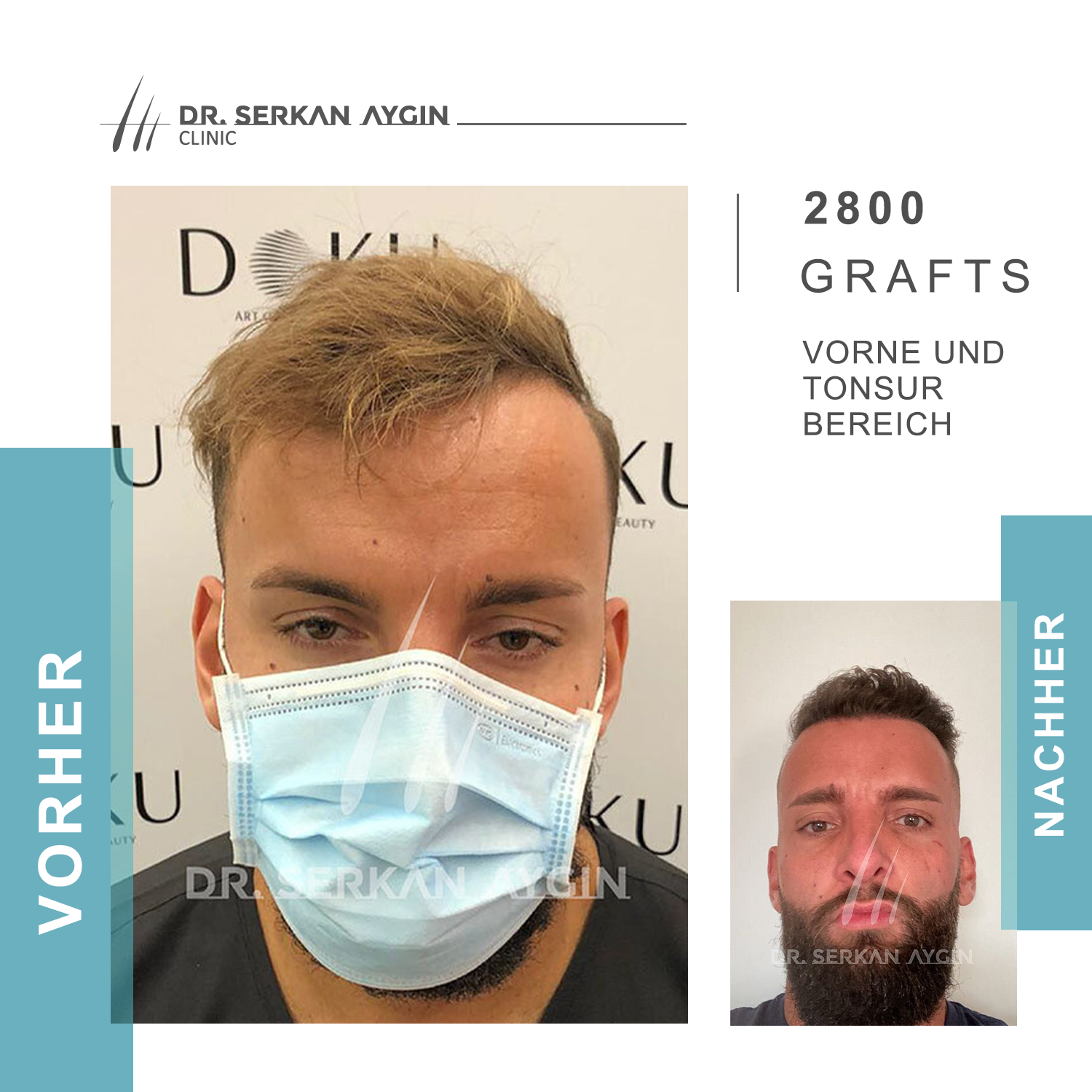 Bild 17 Dr Serkan Aygin | Niederlassung Köln | Haartransplantation Türkei in Köln