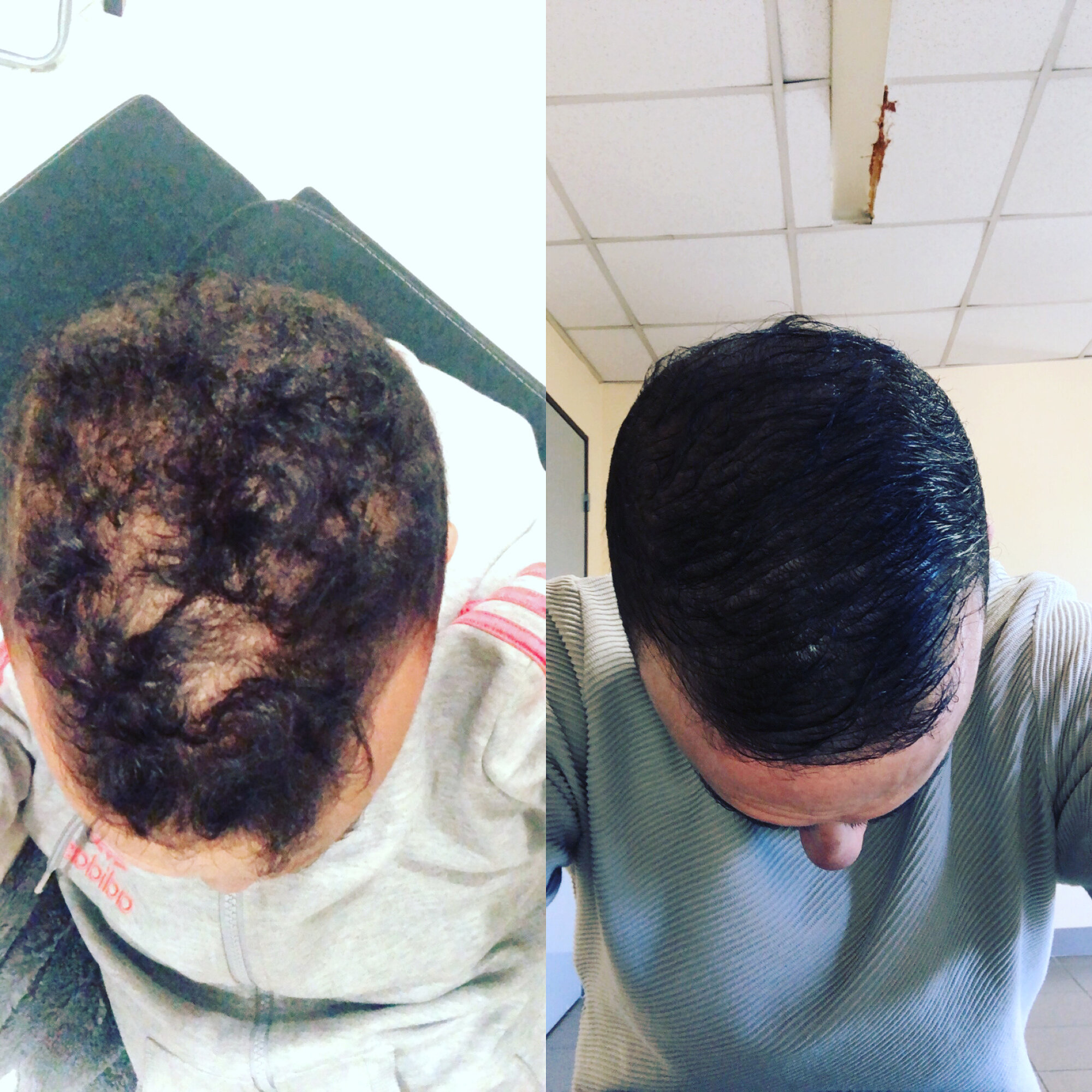 Images Hair clinic solution spécialiste en micropigmentation du cheveux à Marseille