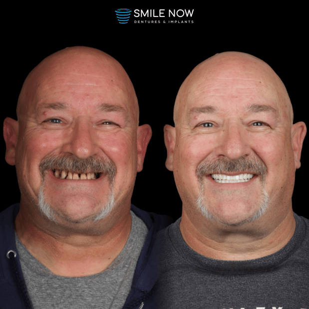 Images Smile Now Milwaukee Dentures and Implants