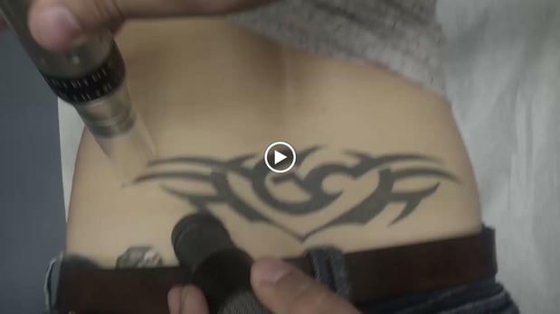 Images TakeTatt Tattoo Removal