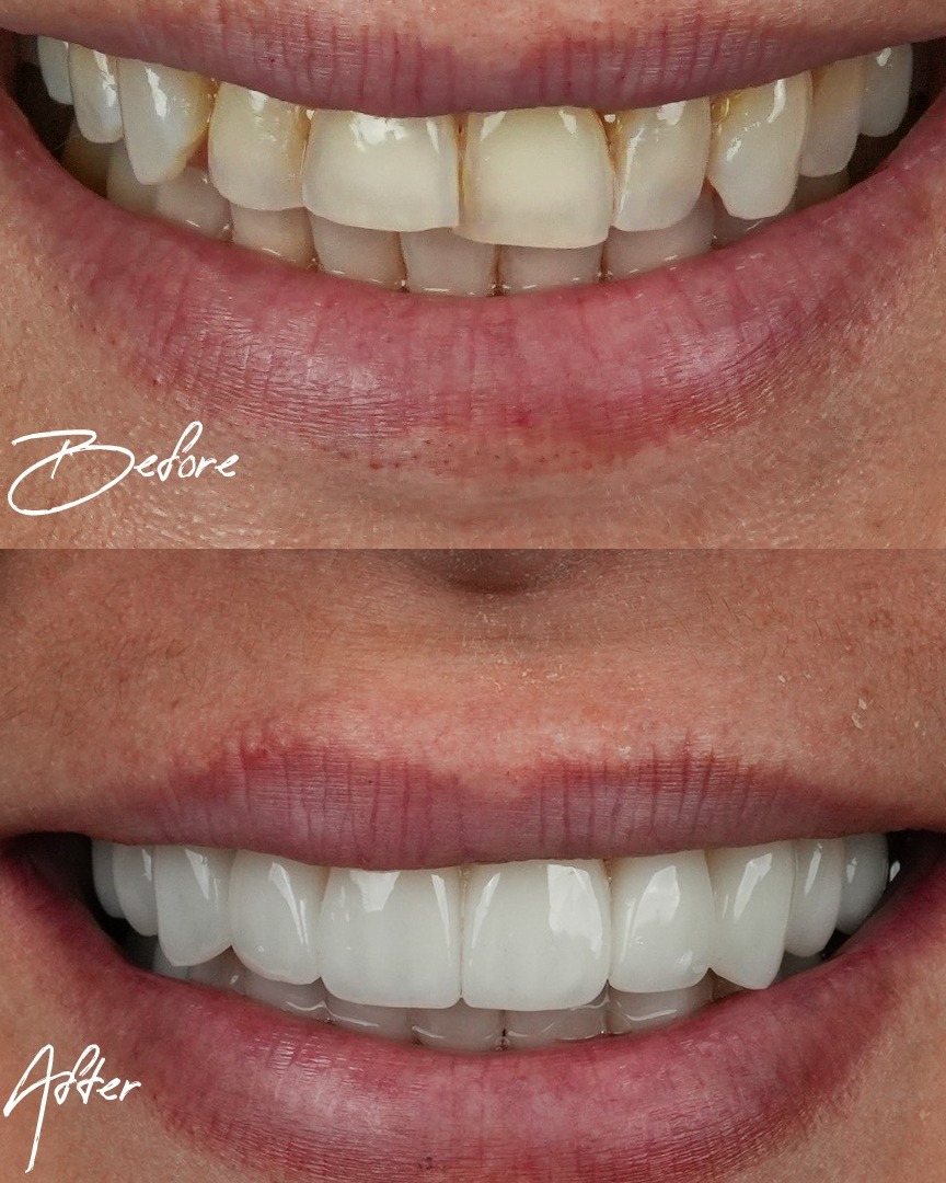 Before and after Porcelain Veneers 