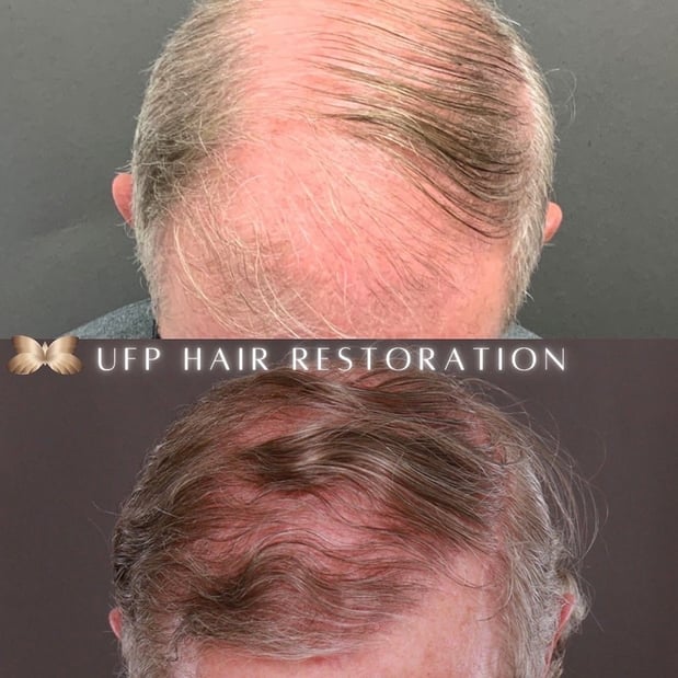 Images UFP Hair Restoration