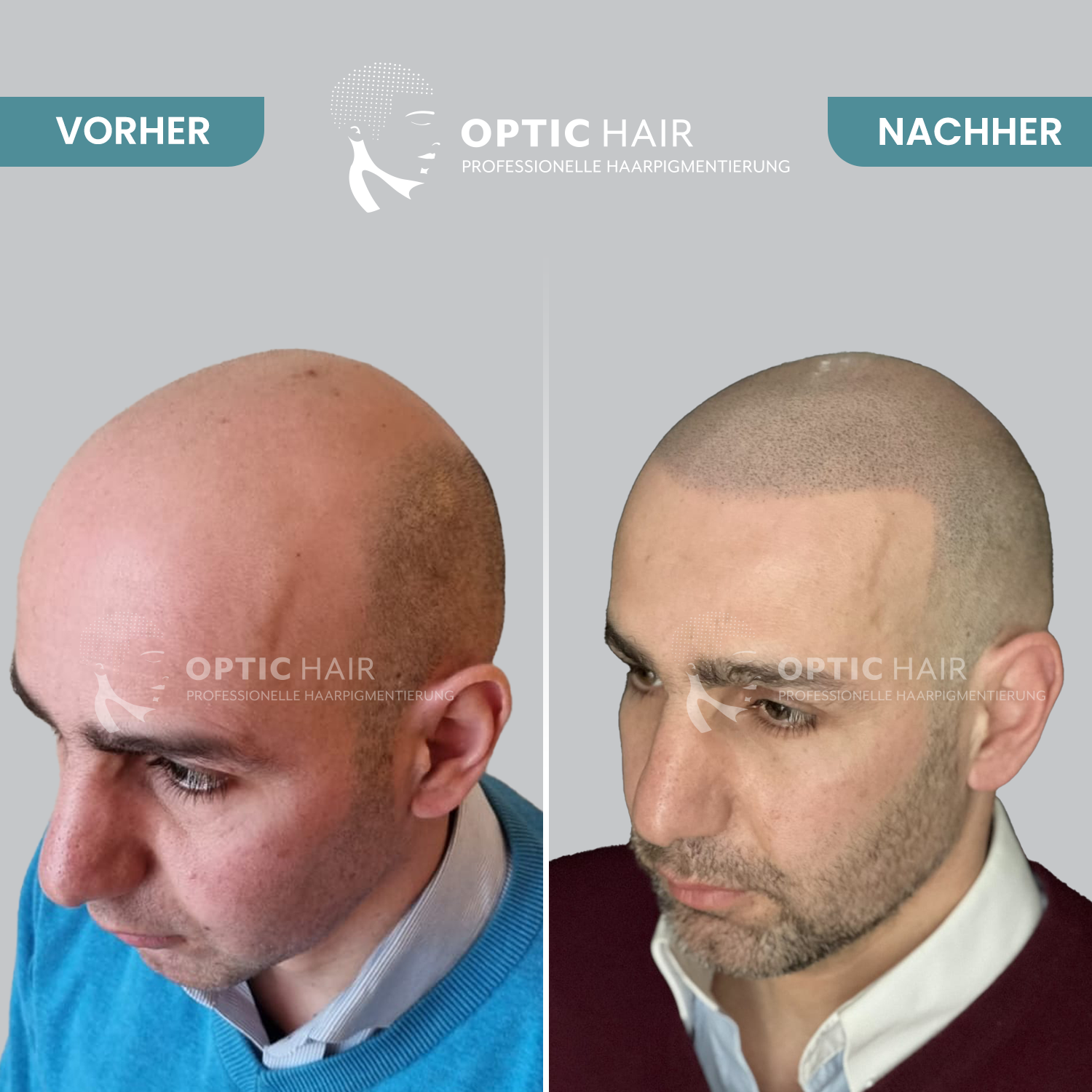 Kundenbild groß 29 Haarpigmentierung Köln | OpticHair