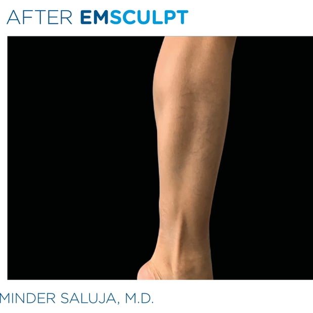 Images Columbus Emsculpt