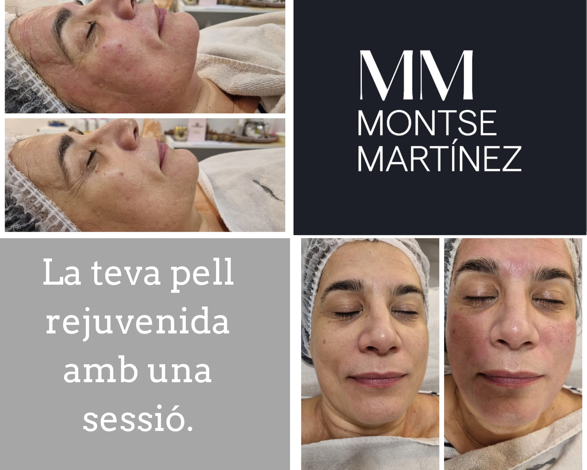 Images Micropigmentación Lleida -  Dermapen LLeida - Montse Martinez