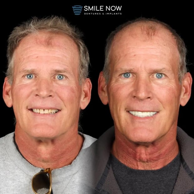 Images Smile Now Milwaukee Dentures and Implants