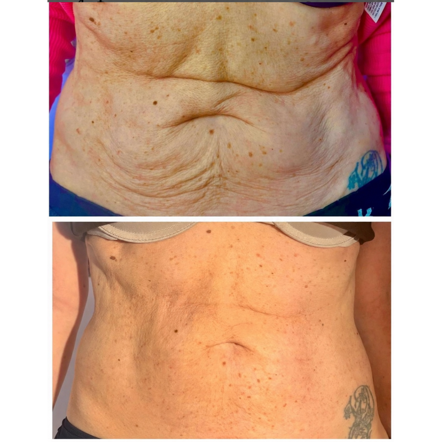 Before-and-after abdominal body-contouring results showing reduced belly fullness and a smoother, more defined midsection following nonsurgical body sculpting at Grace MedSpa in Austin, Texas.