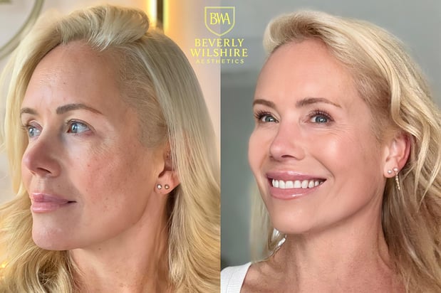 Images Beverly Wilshire Aesthetics Beverly Hills Medical Spa for Botox, Morpheus8, IPL, Lip Fillers
