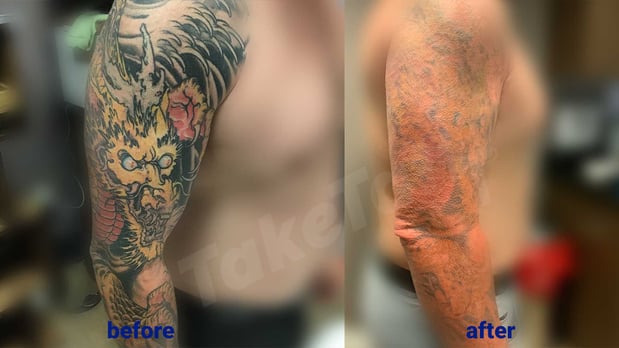 Images TakeTatt Tattoo Removal