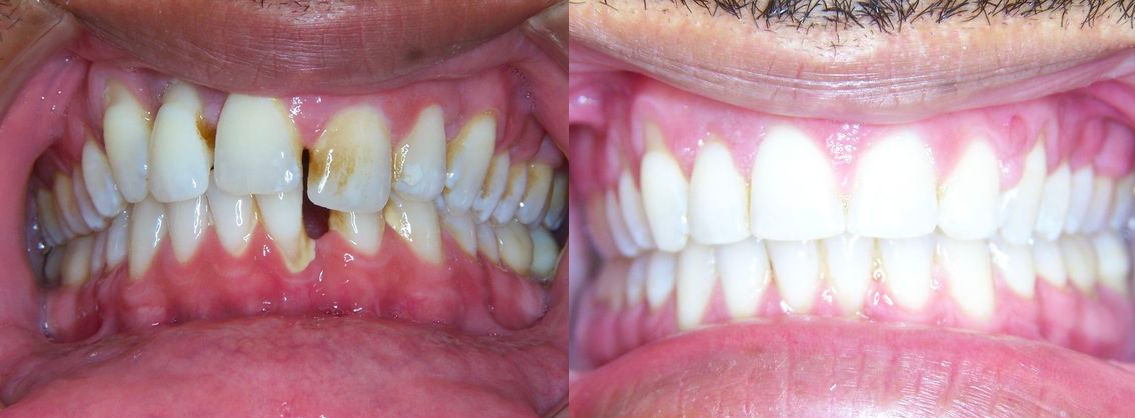 Before & After fromKellyn Hodges Orthodontics | Montgomeryville, PA