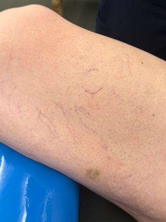 Images Help My Veins