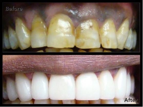 Before-and-after cosmetic dentistry result showing significant improvement in the color, shape, and  