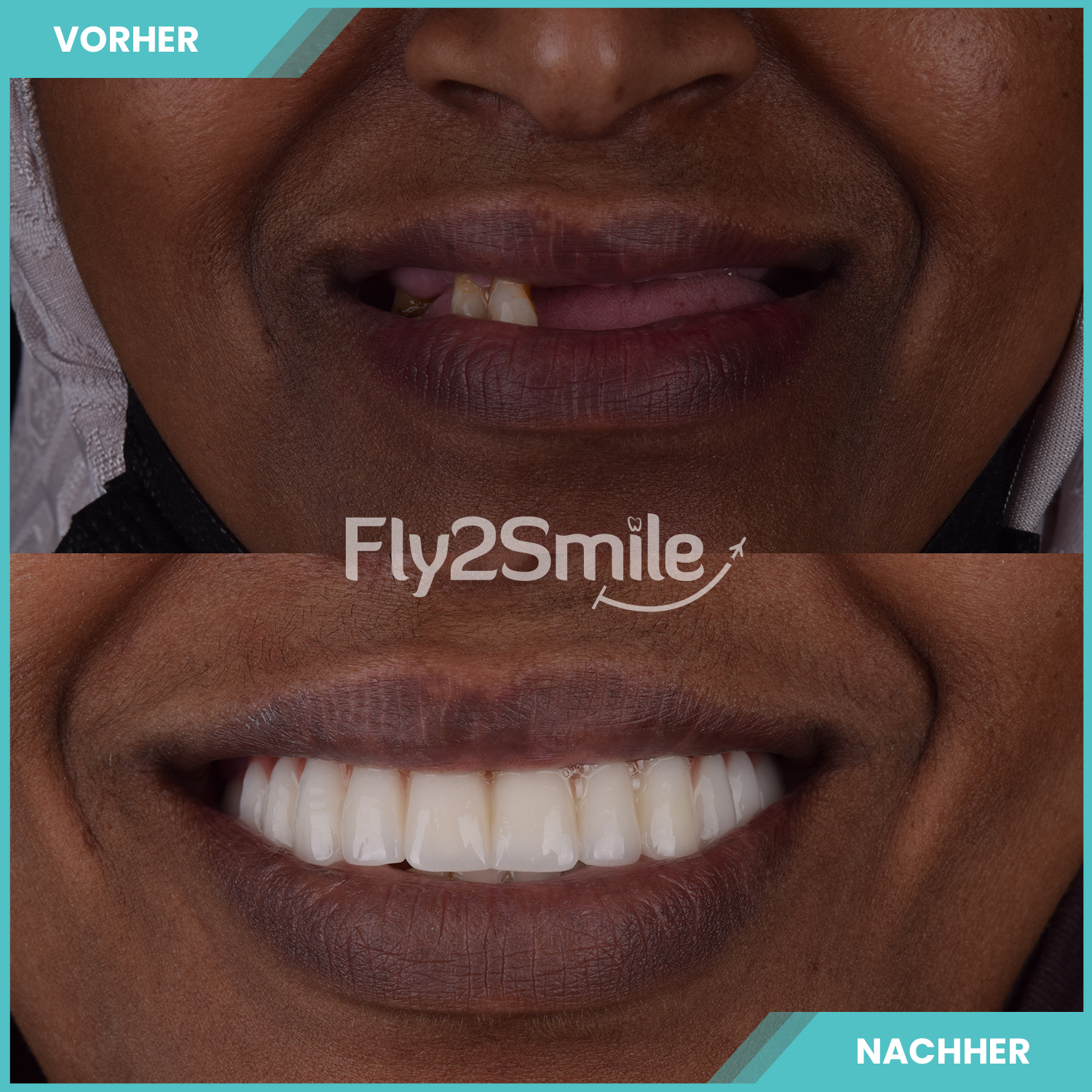 Kundenbild groß 12 Veneers & Zahnimplantate – Zähne machen lassen in der Türkei mit Fly2Smile