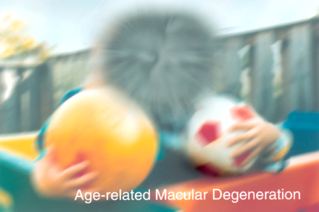 Macular problems cause blurred central vision. This can occur with many macular problems such as macular degeneration, diabetic macular edema, macula pucker or macula hole
