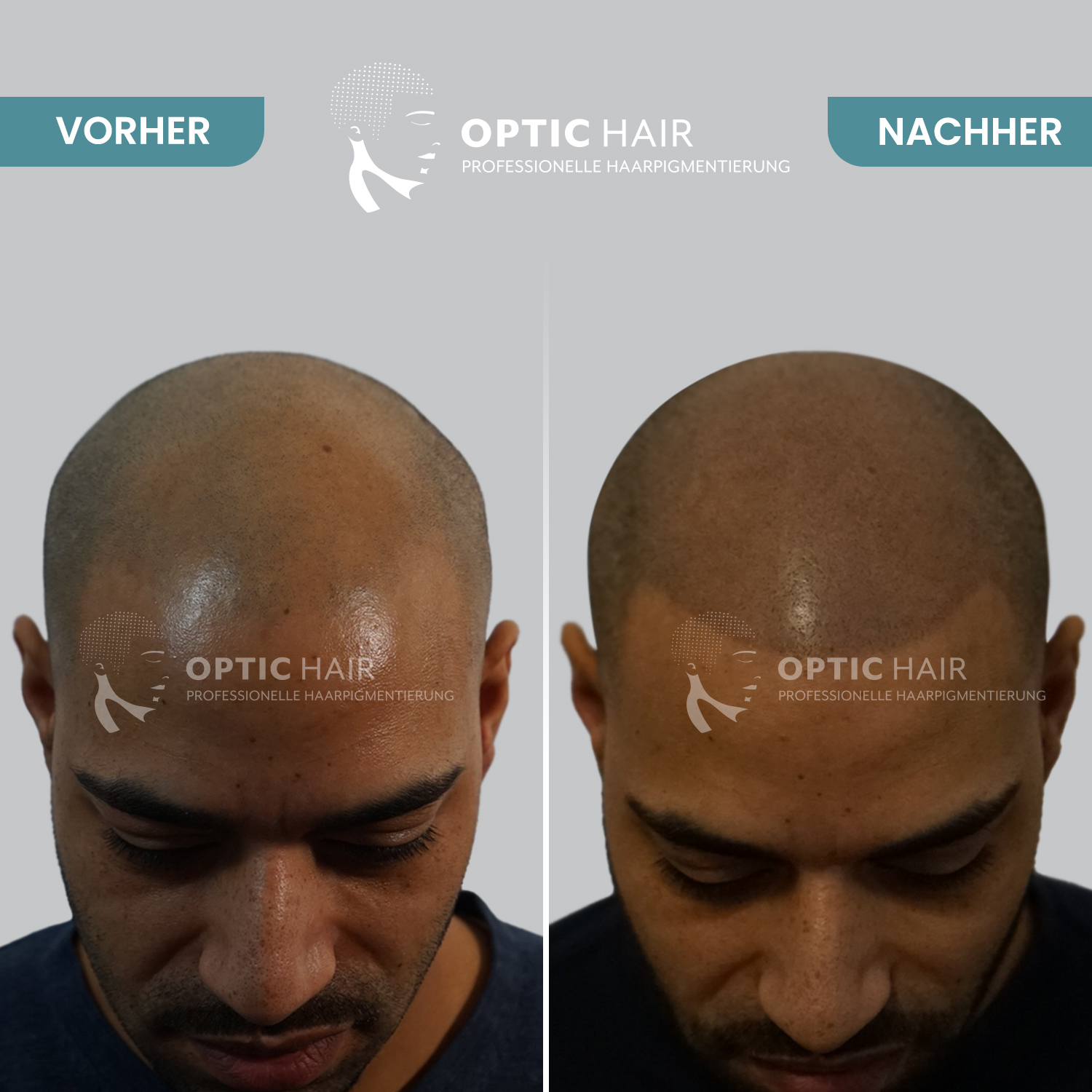 Kundenbild groß 17 Haarpigmentierung Köln | OpticHair