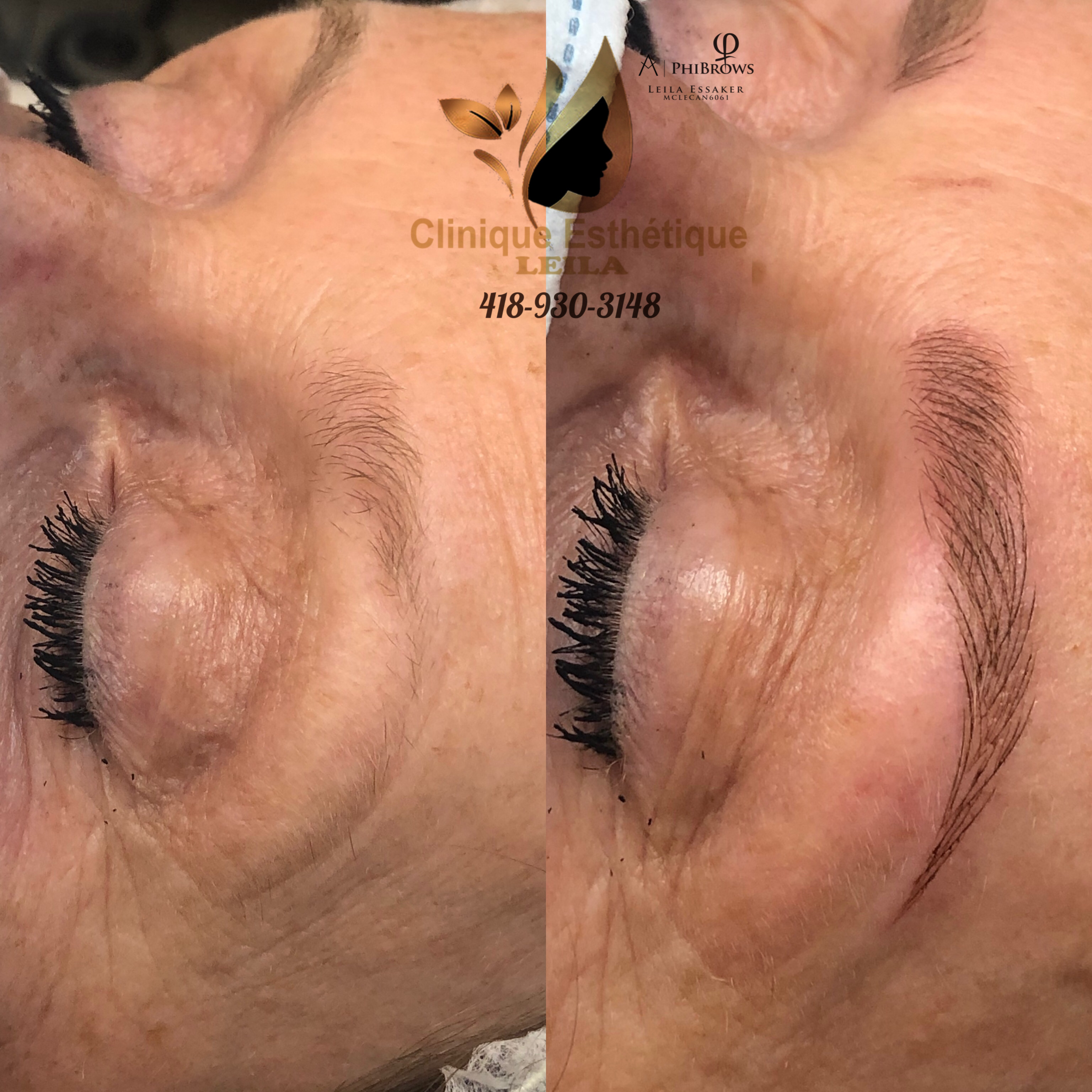Images Clinique d'Esthétique Leila - Hydrafacial, Microblading, Épilation Laser Sainte-Foy