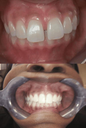 Images SoftTouch Dentistry of Newton