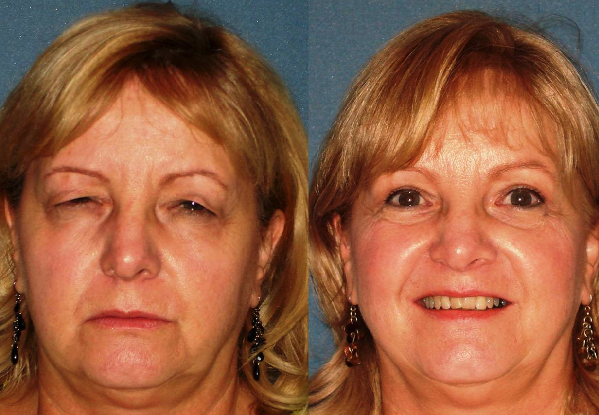 Before & After Results of Arizona Eye Institute & Cosmetic Laser Center | Sin City, AZ, , Facial Plastic Surgeon