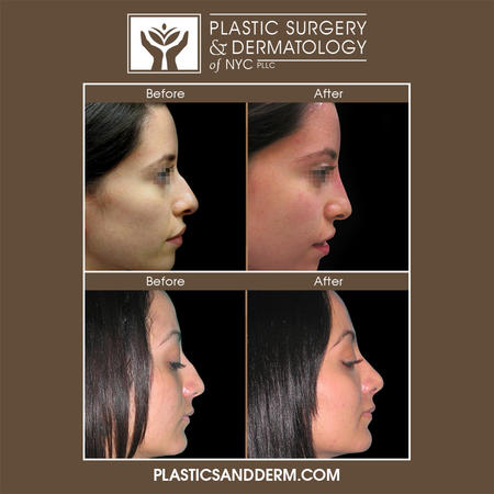 Rhinoplasty is one of the most common cosmetic surgeries which can improve the aesthetics of the face and the functionality of the nose and nostrils through reshaping, resizing, and repairing the nose. By utilizing a personalized approach, rhinoplasty allows patients to achieve optimal facial harmony while maintaining a natural appearance.