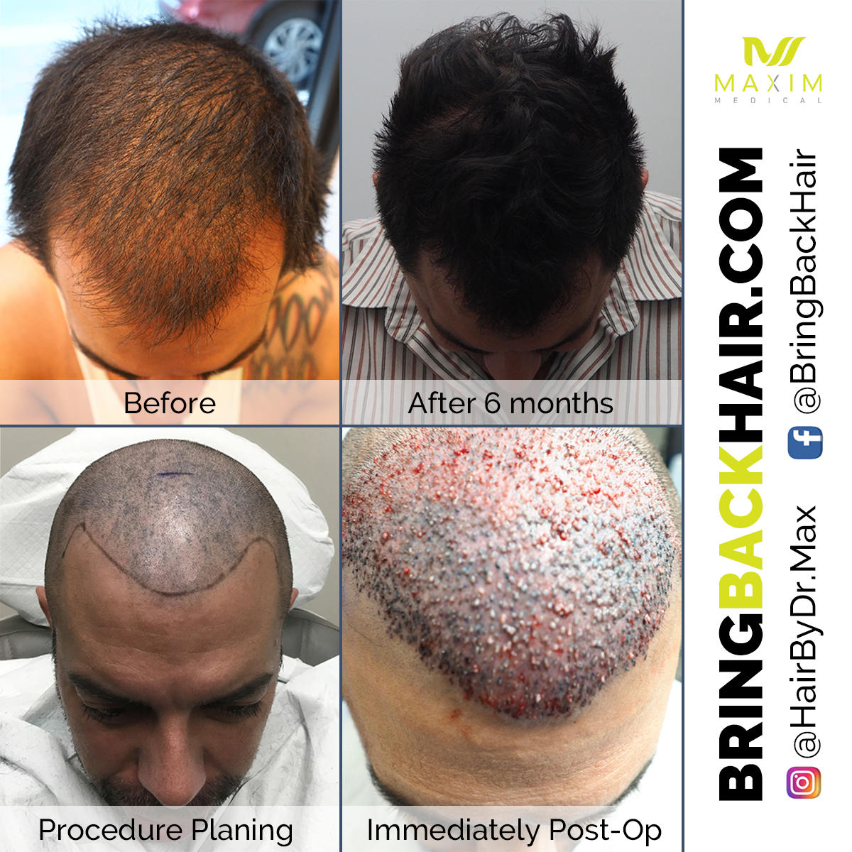 Using ARTAS robotic technology, Dr. Chumak helped restore Francesco’s hair to its full vitality. Want your hair back too? Visit our website to see just how at www.bringbackhair.com , along with other testimonials!