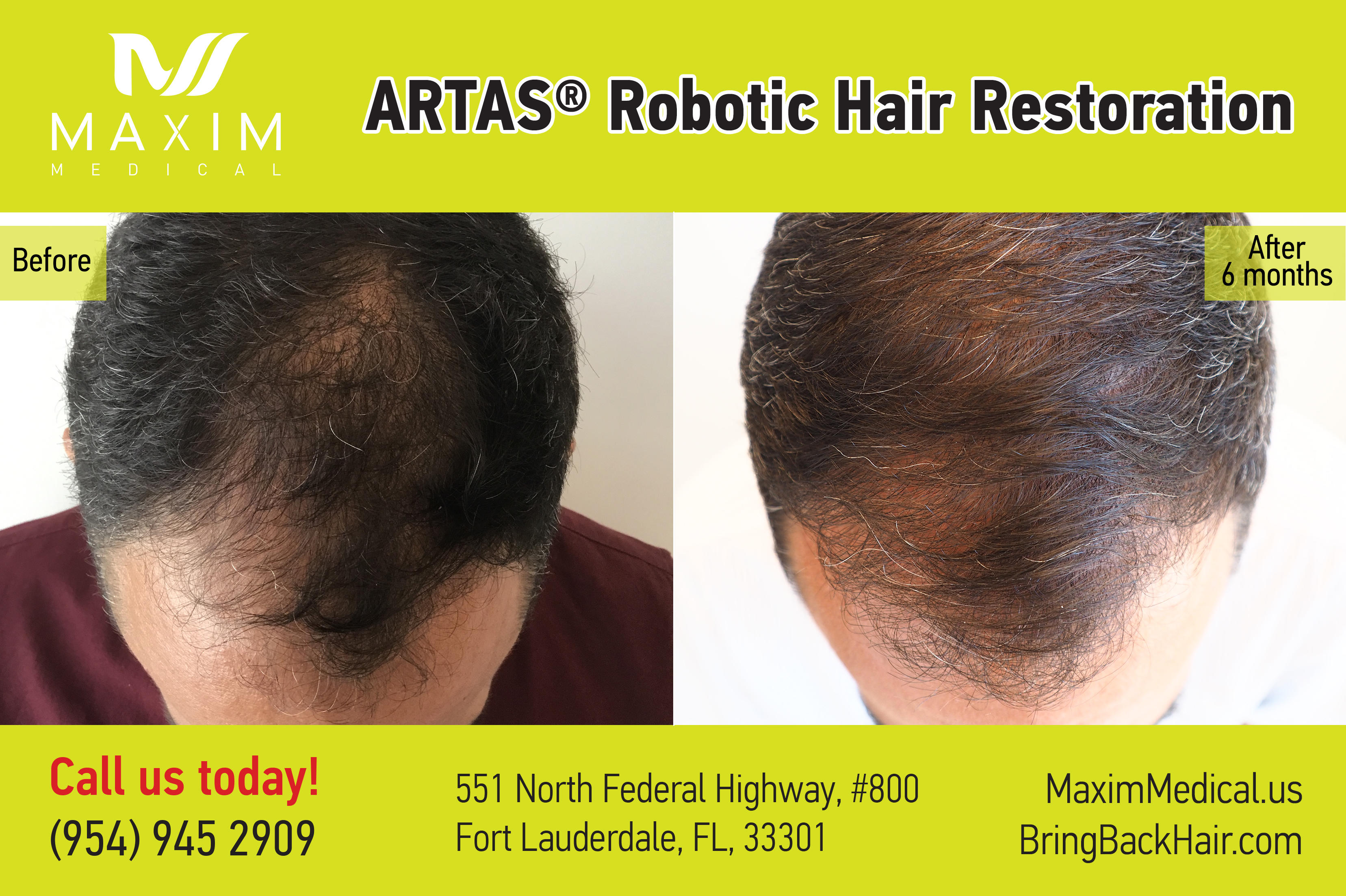 Before&After ARTAS robotic hair transplant surgery. 
Real people - real results!