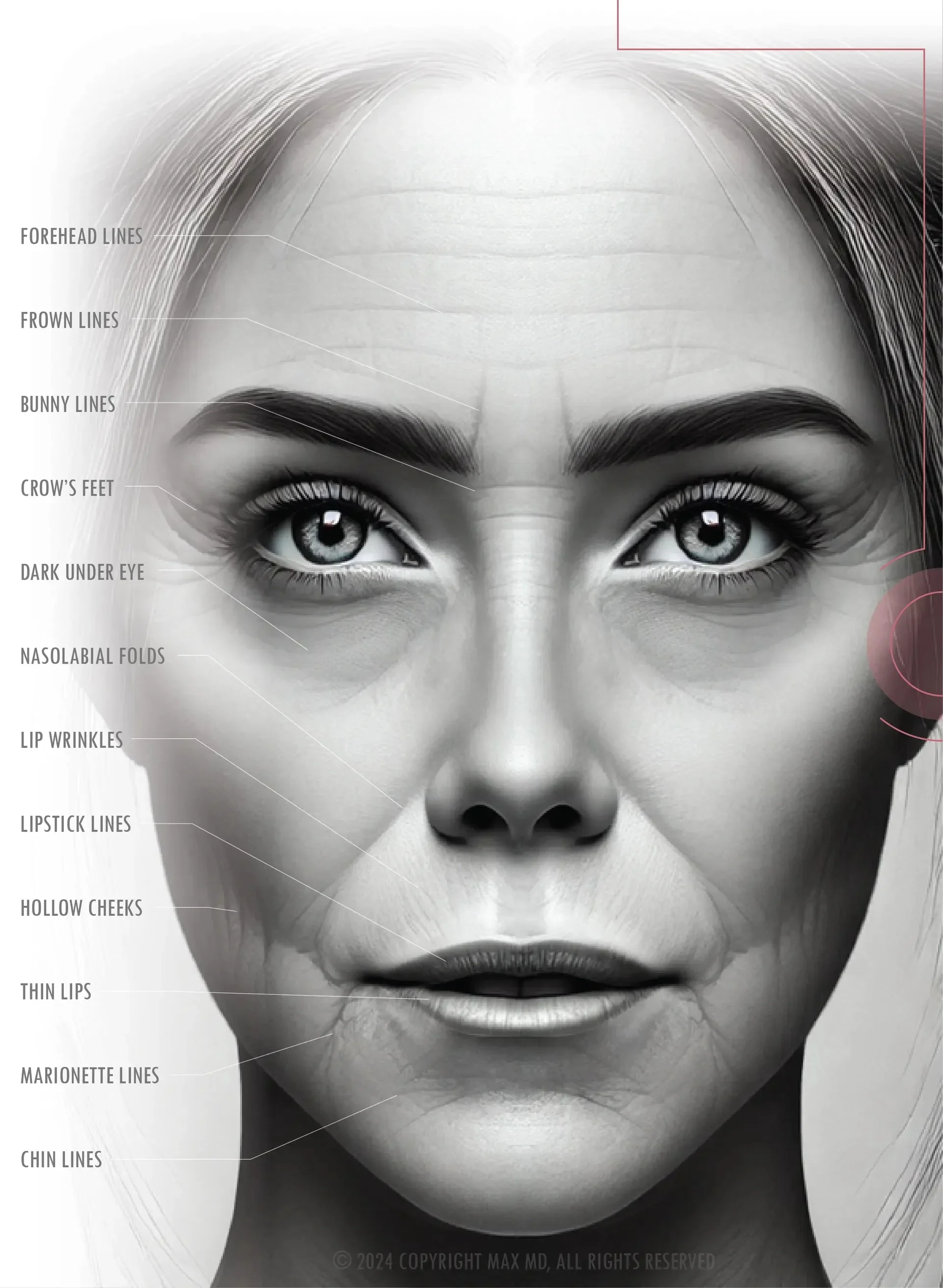 Illustrated facial &ldquo;before&rdquo; guide highlighting common wrinkle and volume-loss areas treated with injectables.