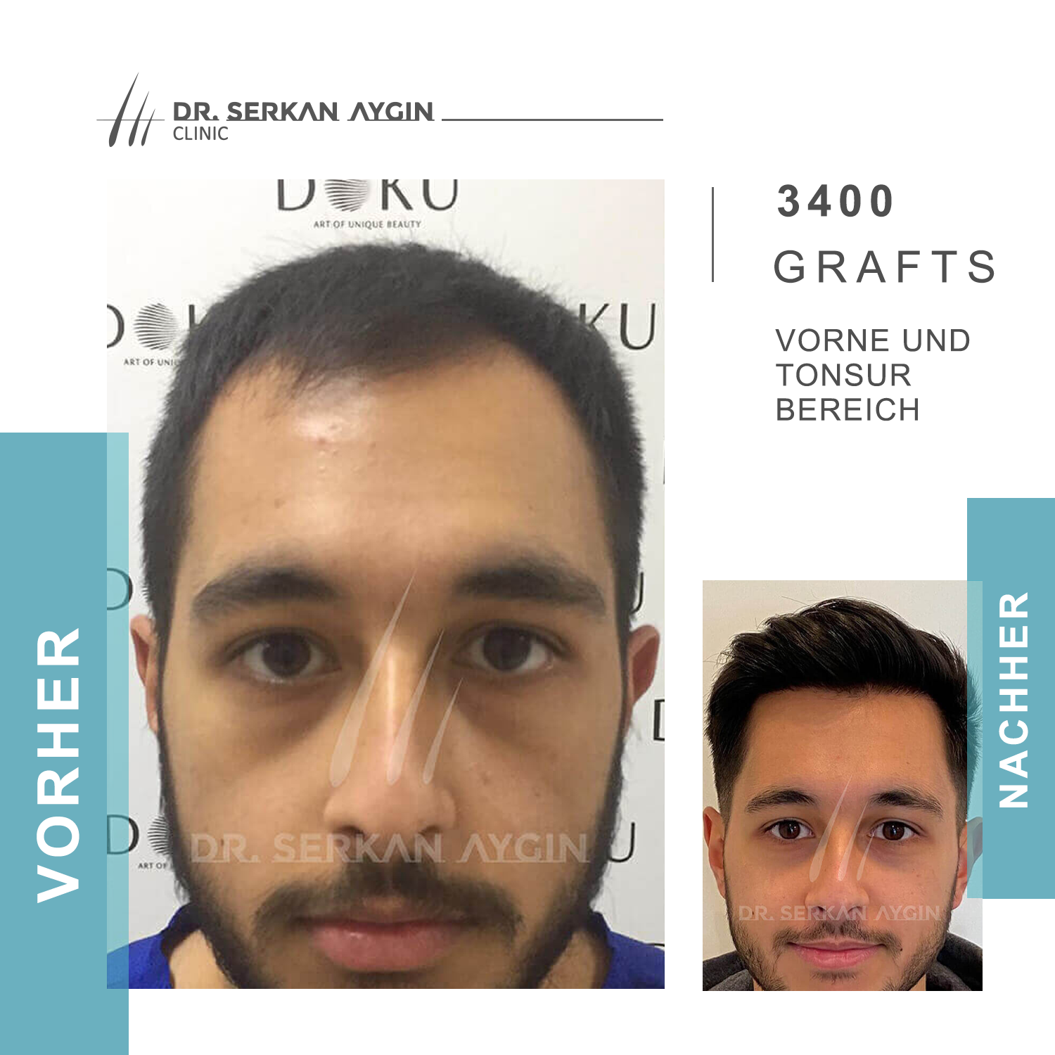 Kundenfoto 10 Dr Serkan Aygin | Niederlassung Berlin | Haartransplantation Türkei