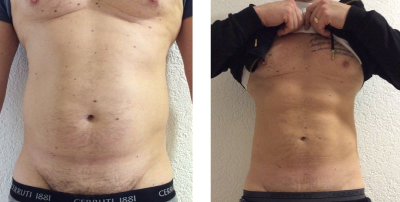 Bilder Medical Aesthetic Fettabsaugen Dr. Urs Benz