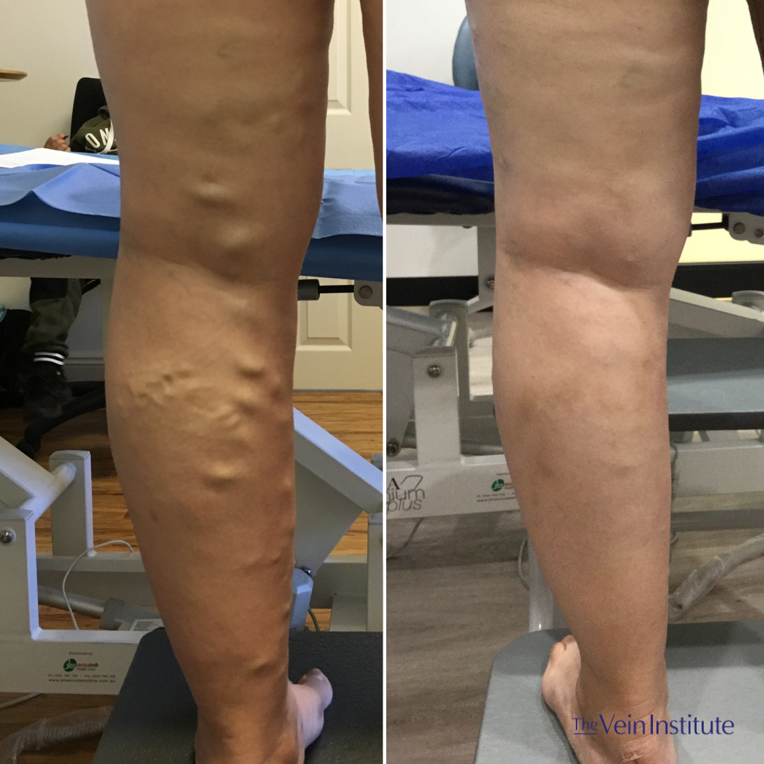 Images The Vein Institute Sydney - Varicose Vein Specialists