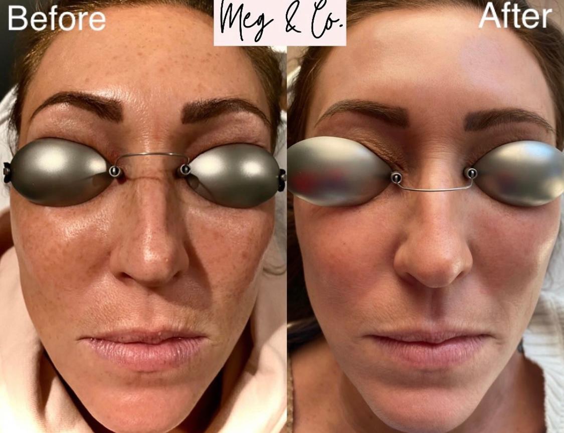 Before and After Two LaseMD Ultra Treatments