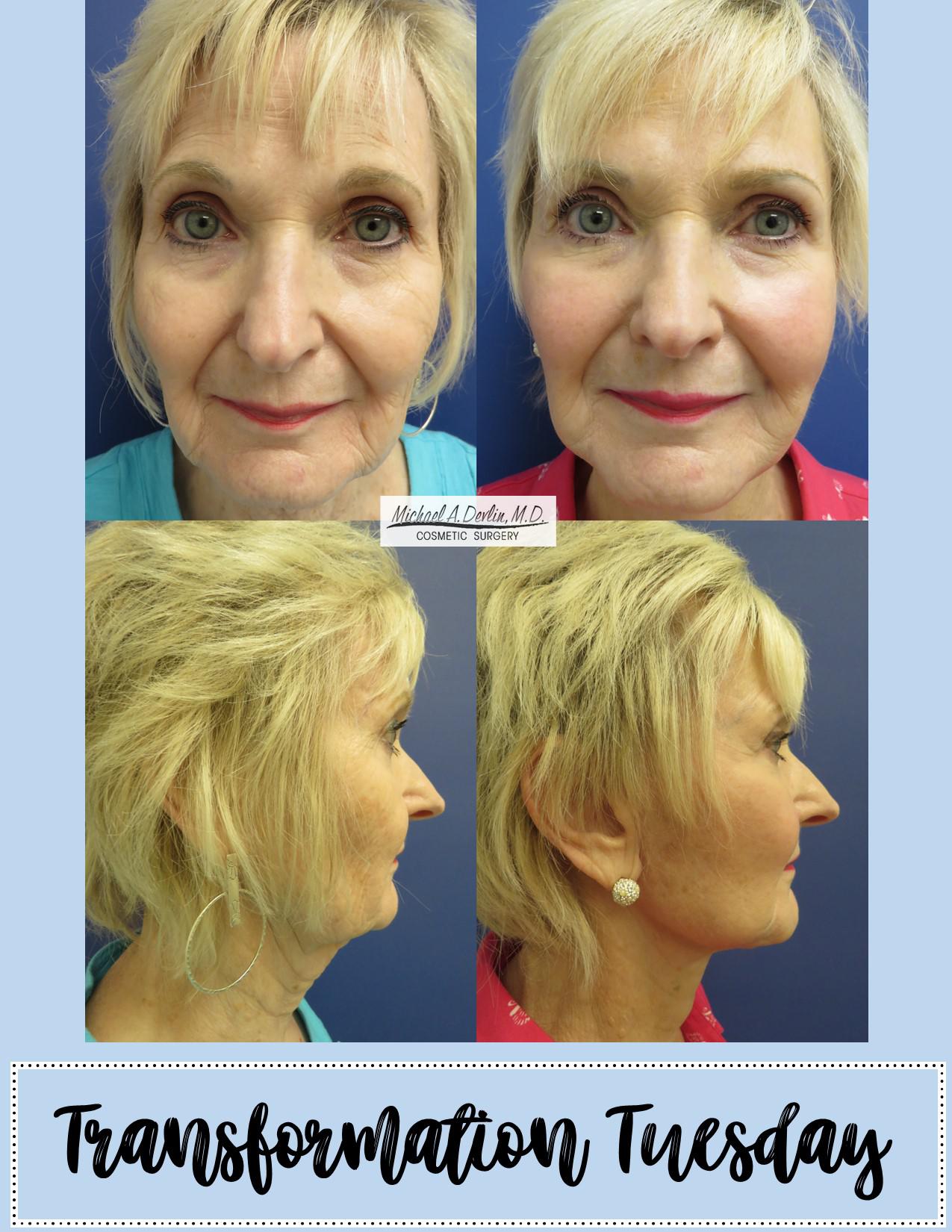 Before & After Results at Devlin Cosmetic Surgery: Michael Devlin, M.D. | Little Rock, AR