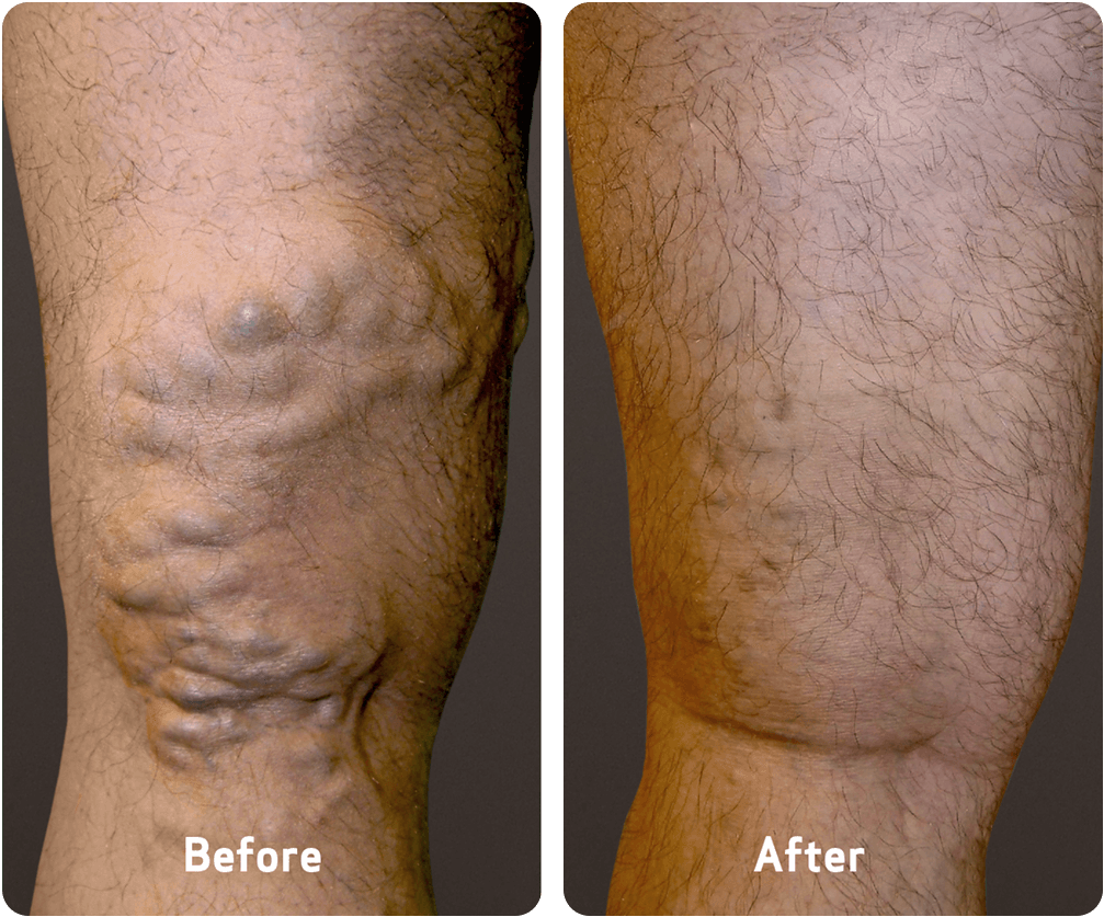 Photo of varicose veins before and after treatment