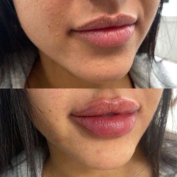 Images Skin Tightening, Botox and Lip Fillers by Skinsation LA