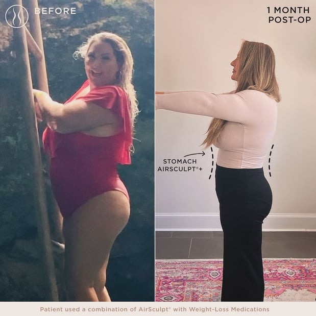 Images AirSculpt - Boston