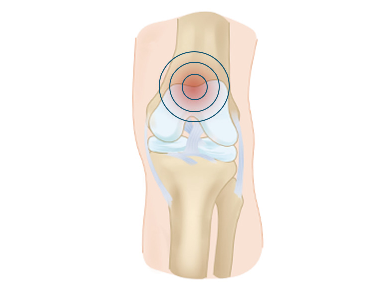 Cncrns_Cndtns-kneepain-Inside-392x294@2x.jpg