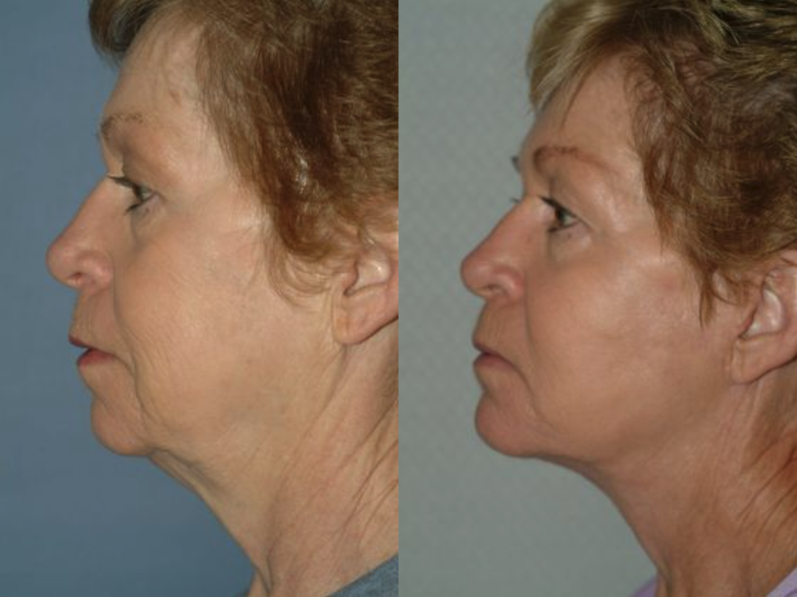 Facelift at The Center for Cosmetic Medicine | Champaign , IL
