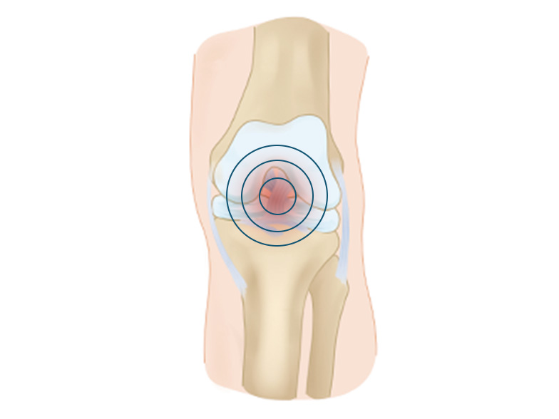 Cncrns_Cndtns-kneepain-inner-392x294@2x.jpg