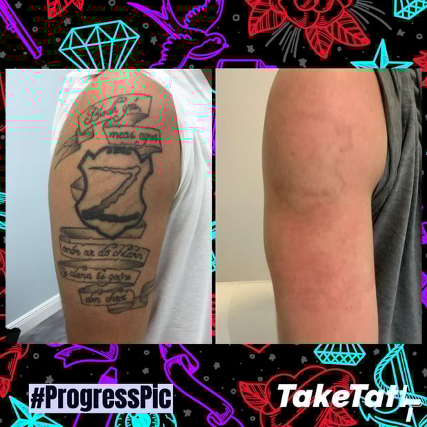 Images TakeTatt Tattoo Removal
