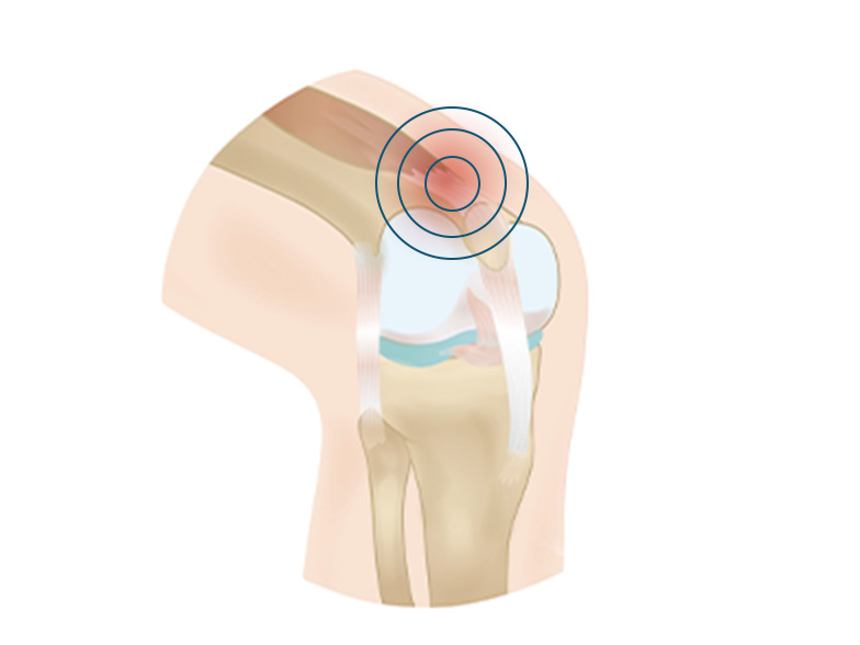 Cncrns_Cndtns-kneepain-above-392x294@2x.jpg