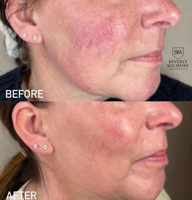 Images Beverly Wilshire Aesthetics Beverly Hills Medical Spa for Botox, Morpheus8, IPL, Lip Fillers