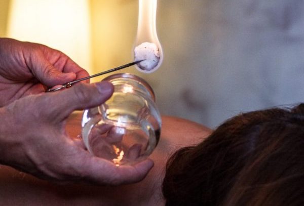 Therapist prepares to perform cupping