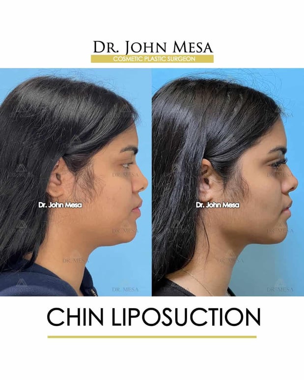 Images Dr. John Mesa, MD: Plastic Surgeon NYC, Buccal Fat Removal, Chin Liposuction, Facelift, Facial Masculinization, Chin Implant