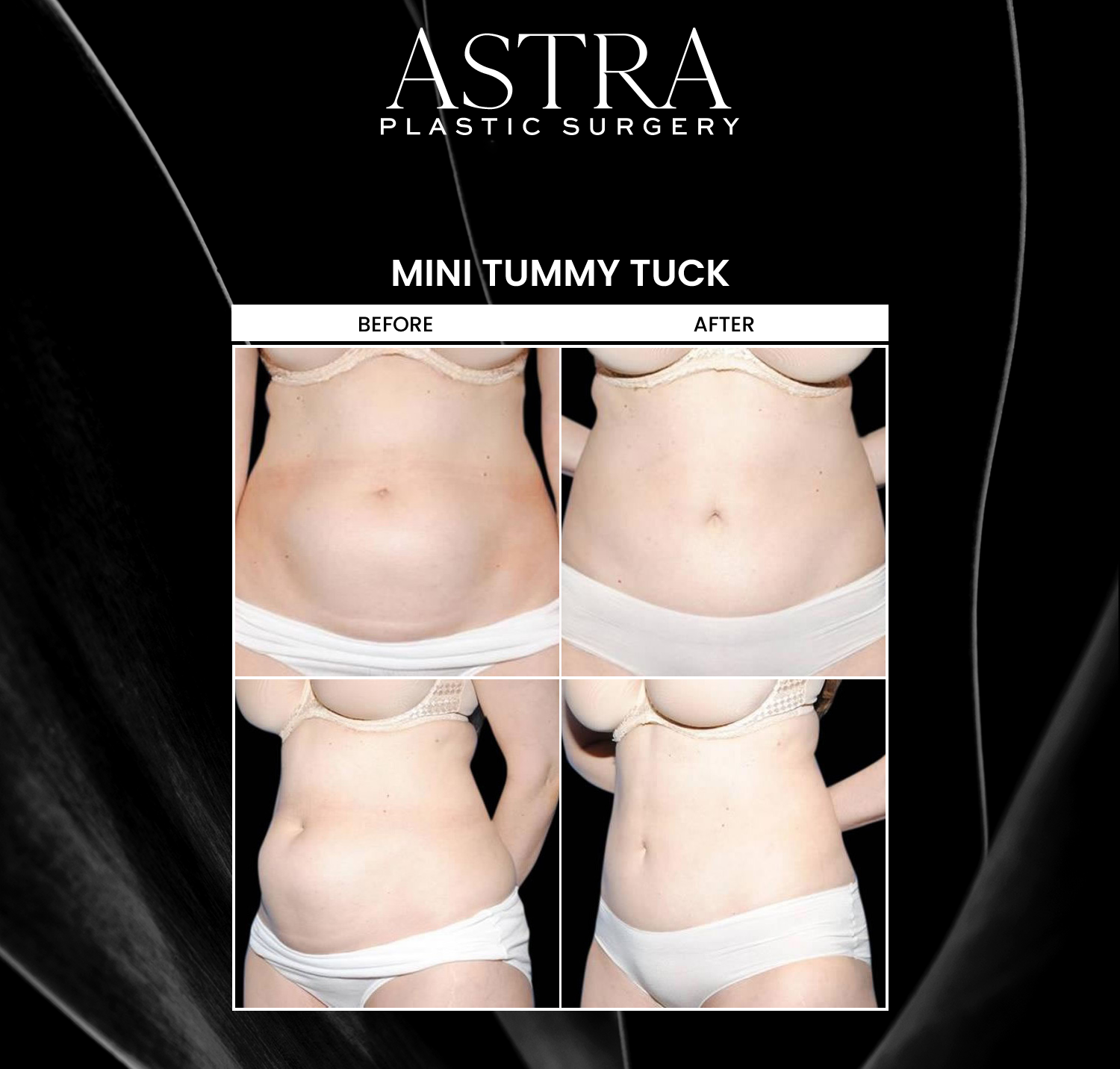 A mini tummy tuck is a body sculpting procedure that can provide patients with a more toned, flatter-looking midsection. This procedure targets the lower abdomen. A mini tummy tuck can restore natural-looking contours of the body without lengthy downtime following the procedure.