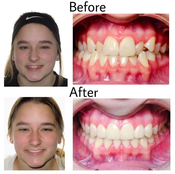 Before & After from Karski & Spokane Orthodontics | Seven Fields, PA