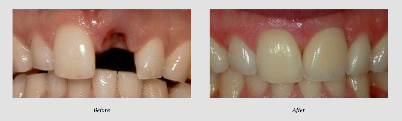 Dental Implant Before & After from Hawaii Pacific Dental Group, Inc. | Honolulu, HI